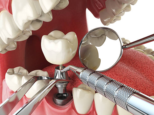 Best Emergency Root Canal Treatment in Prairie Grove, IL